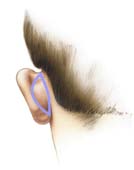 Ear Plastic Surgery, Cosmetic Ear Surgery, Otoplasty Ear Medical Treatment Kolkata India